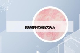 糖尿病牛皮癬能艾灸么