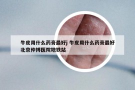牛皮用什么藥膏最好j 牛皮用什么藥膏最好北京仲博醫(yī)院地鐵站