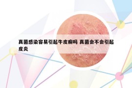 真菌感染容易引起牛皮癬嗎 真菌會不會引起皮炎