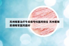 蘇州哪里治療牛皮癬專科醫(yī)院排名 蘇州看銀屑病哪家醫(yī)院最好