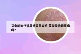 艾灸能治療銀屑病關(guān)節(jié)炎嗎 艾灸能治銀屑病嗎?