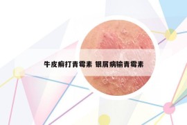 牛皮癬打青霉素 銀屑病輸青霉素