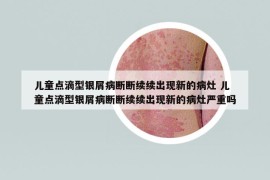 兒童點(diǎn)滴型銀屑病斷斷續(xù)續(xù)出現(xiàn)新的病灶 兒童點(diǎn)滴型銀屑病斷斷續(xù)續(xù)出現(xiàn)新的病灶嚴(yán)重嗎