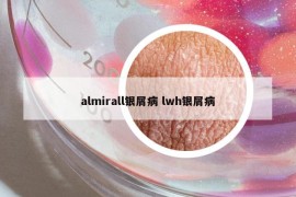 almirall銀屑病 lwh銀屑病