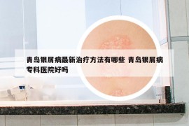 青島銀屑病最新治療方法有哪些 青島銀屑病?？漆t(yī)院好嗎