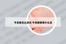 牛皮癬怎么清洗 牛皮膚癬用什么洗