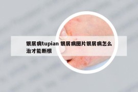 銀屑病tupian 銀屑病圖片銀屑病怎么治才能斷根