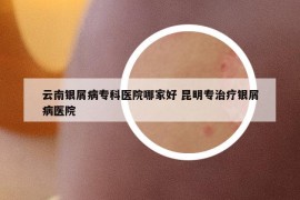 云南銀屑病專科醫(yī)院哪家好 昆明專治療銀屑病醫(yī)院