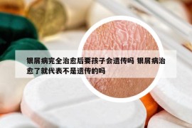 銀屑病完全治愈后要孩子會遺傳嗎 銀屑病治愈了就代表不是遺傳的嗎