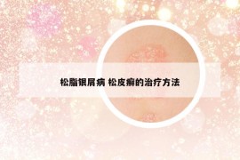 松脂銀屑病 松皮癬的治療方法