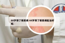 60歲得了銀屑病 60歲得了銀屑病能治好嗎