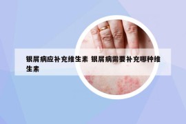 銀屑病應(yīng)補充維生素 銀屑病需要補充哪種維生素