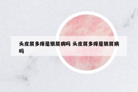頭皮屑多癢是銀屑病嗎 頭皮屑多癢是銀屑病嗎