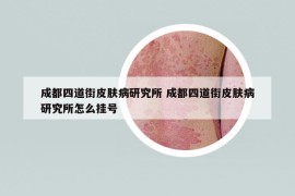 成都四道街皮膚病研究所 成都四道街皮膚病研究所怎么掛號(hào)