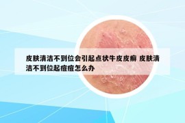 皮膚清潔不到位會引起點(diǎn)狀牛皮皮癬 皮膚清潔不到位起痘痘怎么辦