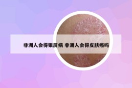 非洲人會得銀屑病 非洲人會得皮膚癌嗎