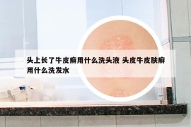 頭上長(zhǎng)了牛皮癬用什么洗頭液 頭皮牛皮膚癬用什么洗發(fā)水