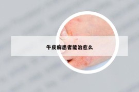 牛皮癬患者能治愈么
