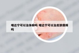 唯達(dá)寧可以治體癬嗎 唯達(dá)寧可以治皮膚瘙癢嗎