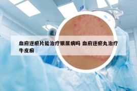 血府逐瘀片能治療銀屑病嗎 血府逐瘀丸治療牛皮癬