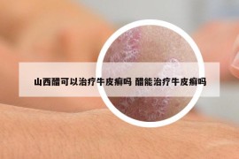 山西醋可以治療牛皮癬嗎 醋能治療牛皮癬嗎