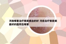 河南哪里治療銀屑病治的好 河南治療銀屑病最好的醫(yī)院在哪里