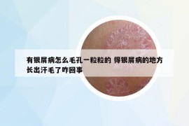有銀屑病怎么毛孔一粒粒的 得銀屑病的地方長(zhǎng)出汗毛了咋回事
