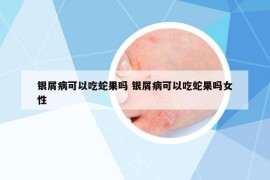 銀屑病可以吃蛇果嗎 銀屑病可以吃蛇果嗎女性