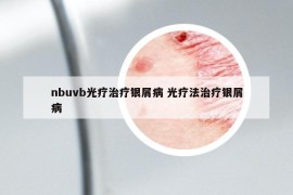 nbuvb光療治療銀屑病 光療法治療銀屑病