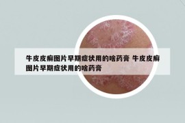牛皮皮癬圖片早期癥狀用的啥藥膏 牛皮皮癬圖片早期癥狀用的啥藥膏