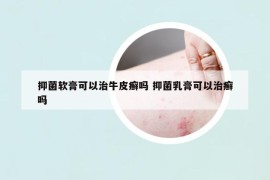 抑菌軟膏可以治牛皮癬嗎 抑菌乳膏可以治癬嗎