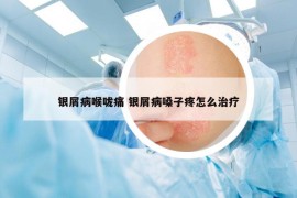 銀屑病喉嚨痛 銀屑病嗓子疼怎么治療