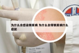 為什么會感染銀屑病 為什么會得銀屑病什么癥狀