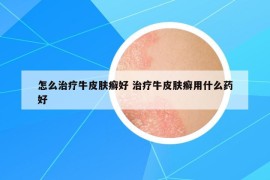 怎么治療牛皮膚癬好 治療牛皮膚癬用什么藥好