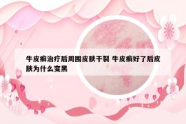 牛皮癬治療后周圍皮膚干裂 牛皮癬好了后皮膚為什么變黑