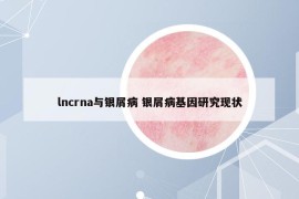 lncrna與銀屑病 銀屑病基因研究現(xiàn)狀