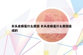 長頭皮癬是什么原因 長頭皮癬是什么原因造成的