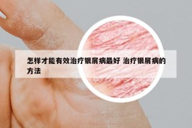 怎樣才能有效治療銀屑病最好 治療銀屑病的方法