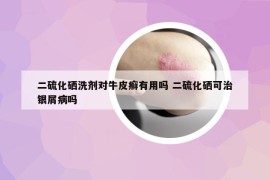 二硫化硒洗劑對牛皮癬有用嗎 二硫化硒可治銀屑病嗎