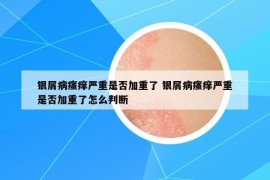 銀屑病瘙癢嚴重是否加重了 銀屑病瘙癢嚴重是否加重了怎么判斷
