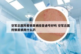 空軍總醫(yī)院看銀屑病掛普通號好嗎 空軍總醫(yī)院銀屑病用什么藥