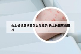 頭上長(zhǎng)銀屑病是怎么發(fā)現(xiàn)的 頭上長(zhǎng)銀屑病圖片