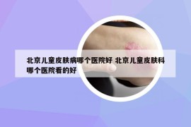 北京兒童皮膚病哪個(gè)醫(yī)院好 北京兒童皮膚科哪個(gè)醫(yī)院看的好
