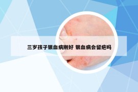 三歲孩子銀血病剛好 銀血病會留疤嗎