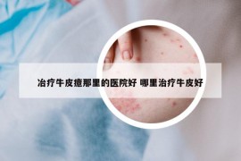 冶療牛皮癔那里的醫(yī)院好 哪里治療牛皮好