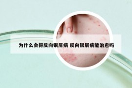 為什么會(huì)得反向銀屑病 反向銀屑病能治愈嗎