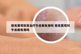 他克莫司軟膏治療牛皮癬有用嗎 他克莫司對(duì)牛皮癬有用嗎
