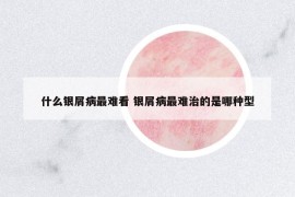 什么銀屑病最難看 銀屑病最難治的是哪種型