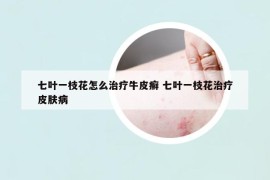 七葉一枝花怎么治療牛皮癬 七葉一枝花治療皮膚病