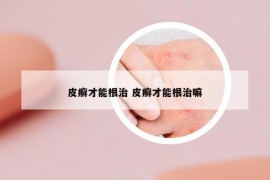 皮癬才能根治 皮癬才能根治嘛
